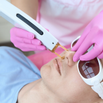 First Photofacial Near Olney MD